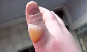 حکم آب تاول چیست؟