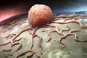 گرما رشد سلول های سرطانی را دشوار می‌کند