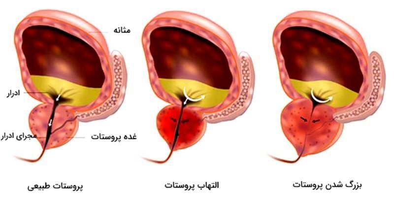 پروستات