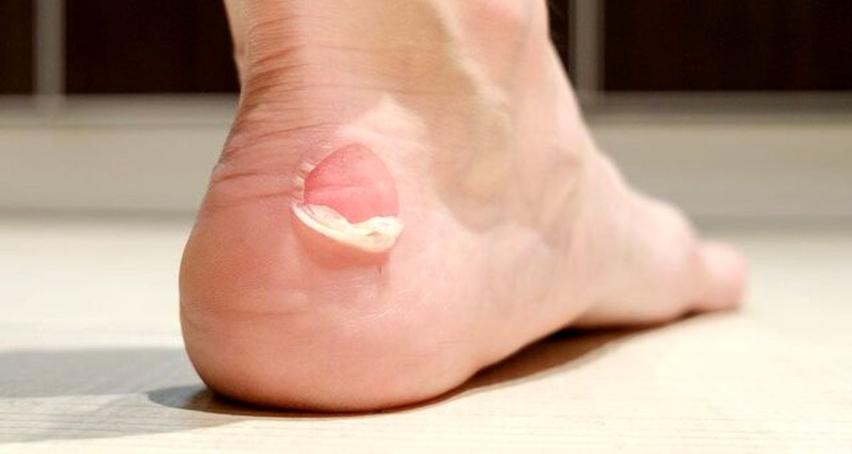 چرا تاول می زنیم؟