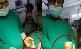 کشف لیوان فولادی در معده یک مرد