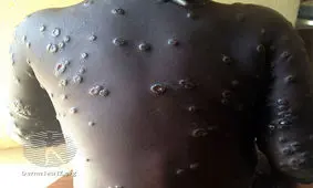 آبله میمون؛ یک همه‌گیری جدید در راه است؟