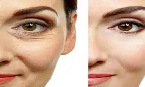 بوتاکس صورت به روش طبیعی در منزل