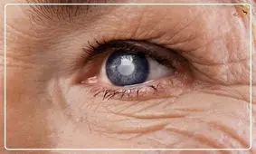 آب مروارید؛  شایع ترین علت نابینایی/  ویدئو