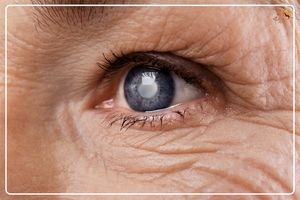 آب مروارید؛  شایع ترین علت نابینایی/  ویدئو