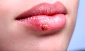 آیا آفت و تبخال با استرس تشدید می‌شوند؟