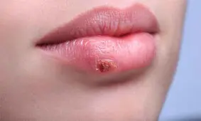 آیا آفت و تبخال با استرس تشدید می‌شوند؟