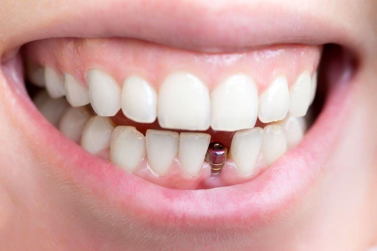 ایمپلنت دندان یک روزه و فوری

