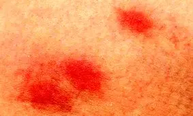 تب و استفراغ؛ علائم ویروسی که با گزش کنه به جانتان می‌افتد