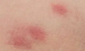 تب و استفراغ؛ علائم ویروسی که با گزش کنه به جانتان می‌افتد