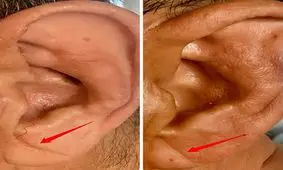 چین‌ خوردگی‌های لاله گوش، خبر از یک بیماری مهم می‌دهد